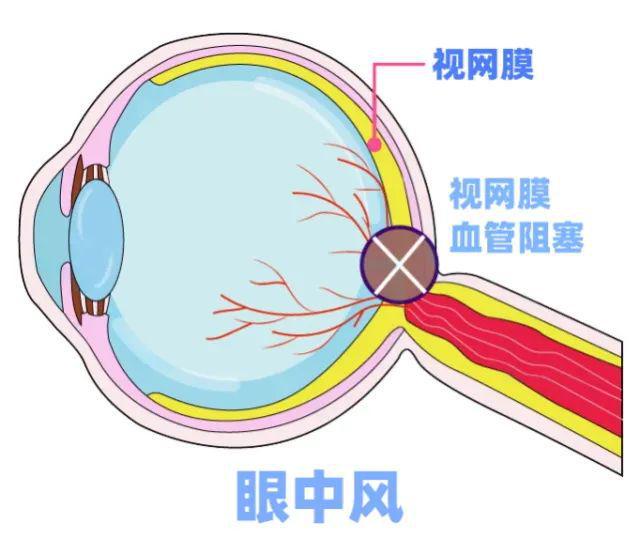 “看地砖像水波一样”！“95后”睡醒失明这病年轻化易错过救治时机！(图2)